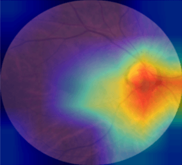 Multimodal Glaucoma Classification Using Segmentation Based Biomarker Extraction paper